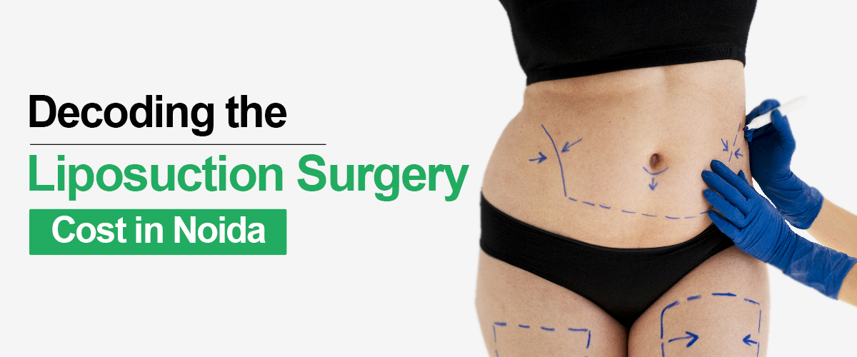 Decoding Liposuction Surgery Cost in Noida