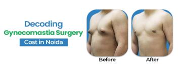 Gynecomastia Surgery Cost in Noida